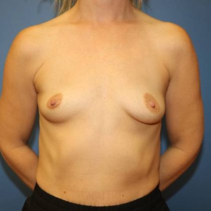 Breast Augmentation Before & After Patient #8052