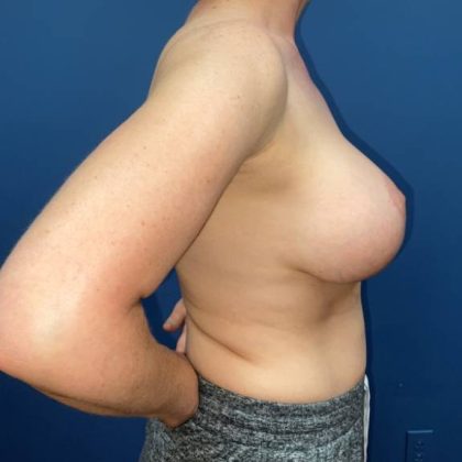 Breast Augmentation Before & After Patient #8053