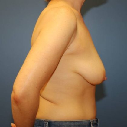 Breast Augmentation Before & After Patient #8053