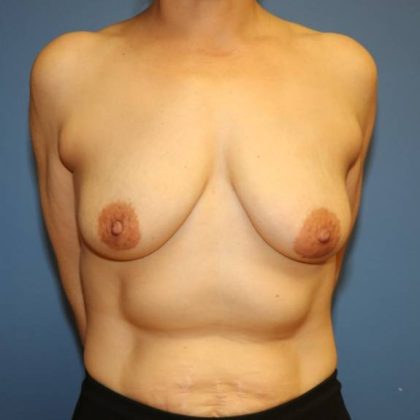 Breast Augmentation Before & After Patient #8054