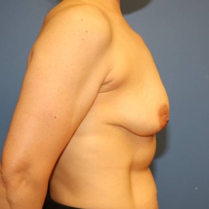 Breast Augmentation Before & After Patient #8054