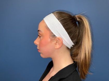 Rhinoplasty Before & After Patient #8122