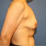 Breast Augmentation Before & After Patient #8102