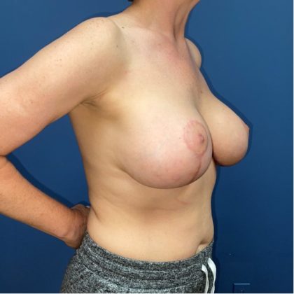 Breast Augmentation Before & After Patient #8101