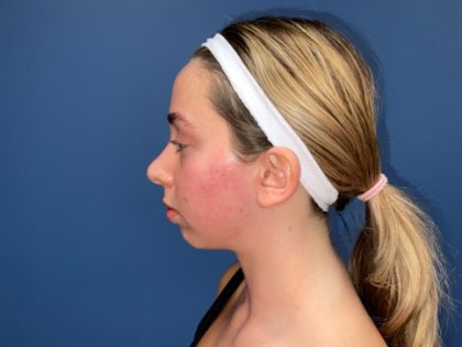Rhinoplasty Before & After Patient #8122