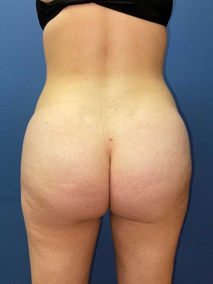 Brazilian Butt Lift Before & After Patient #8001