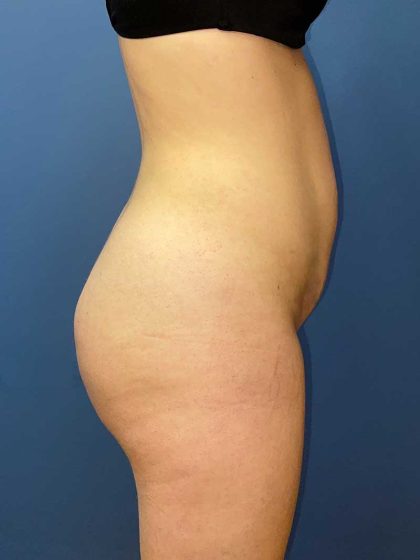 Brazilian Butt Lift Before & After Patient #8001