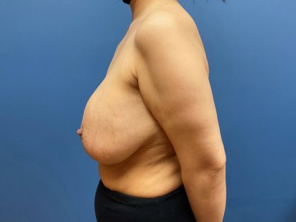 Breast Lift Before & After Patient #8153