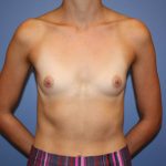 Breast Augmentation Before & After Patient #8164