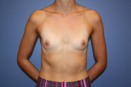Breast Augmentation Before & After Patient #8164