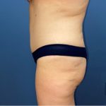 Tummy Tuck Before & After Patient #8278