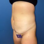 Tummy Tuck Before & After Patient #8304