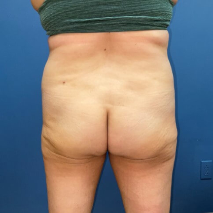 Tummy Tuck Before & After Patient #8278