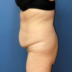 Tummy Tuck Before & After Patient #8311