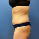 Tummy Tuck Before & After Patient #8311