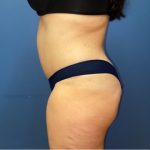 Tummy Tuck Before & After Patient #8291