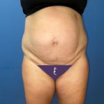 Tummy Tuck Before & After Patient #8291