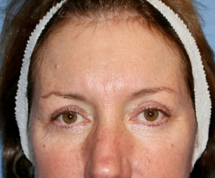 Eyelid Lift Before & After Patient #8321