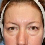 Eyelid Lift Before & After Patient #8321