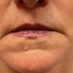 Lip Lift Before & After Patient #8185