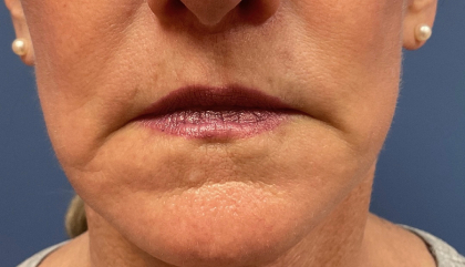 Lip Lift Before & After Patient #8185