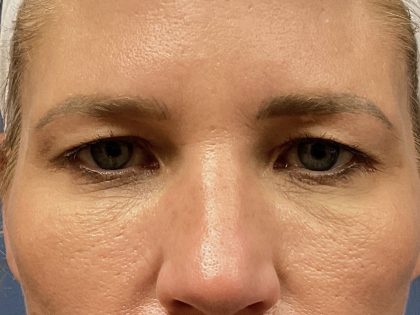 Eyelid Lift Before & After Patient #8228