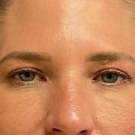Eyelid Lift Before & After Patient #8228