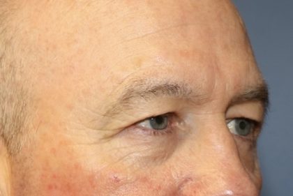 Eyelid Lift Before & After Patient #8223