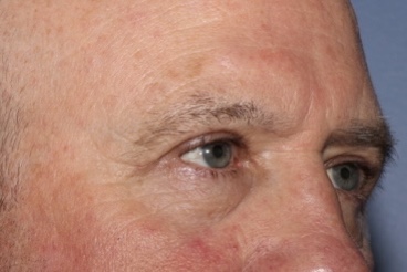 Eyelid Lift Before & After Patient #8223
