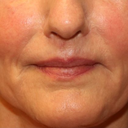 Lip Lift Before & After Patient #8177