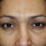 Eyelid Lift Before & After Patient #8242