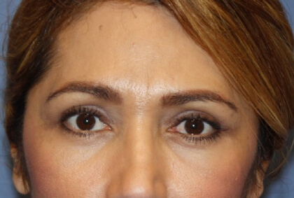 Eyelid Lift Before & After Patient #8242