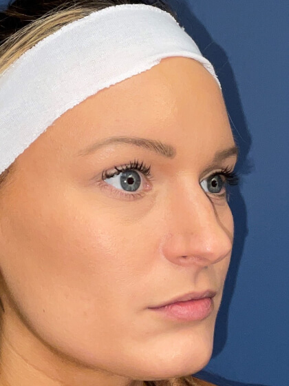 Rhinoplasty Before & After Patient #8247
