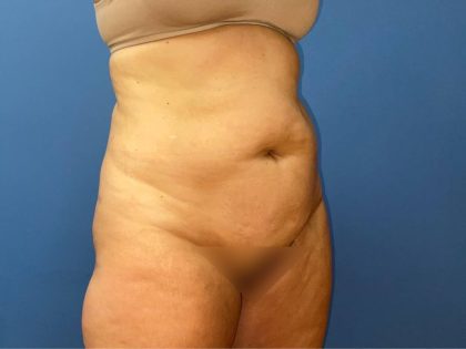 Tummy Tuck Before & After Patient #8209