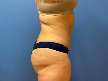 Tummy Tuck Before & After Patient #8209