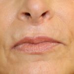 Lip Lift Before & After Patient #8329