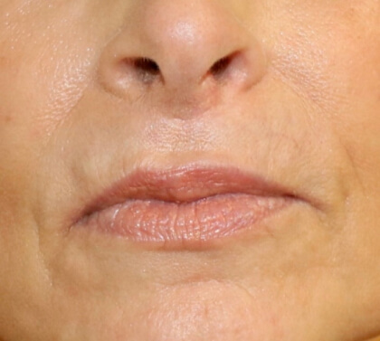 Lip Lift Before & After Patient #8329