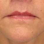 Lip Lift Before & After Patient #8326