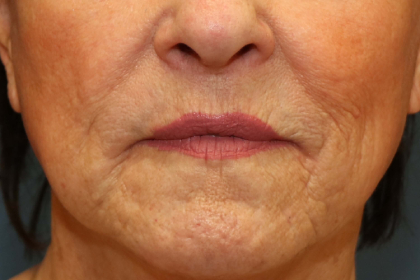 Lip Lift Before & After Patient #8332