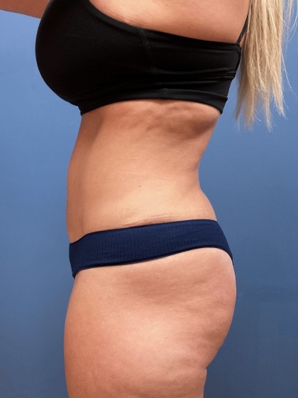 Liposuction Before & After Patient #8343