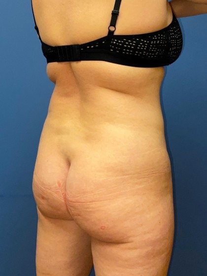 Liposuction Before & After Patient #8343