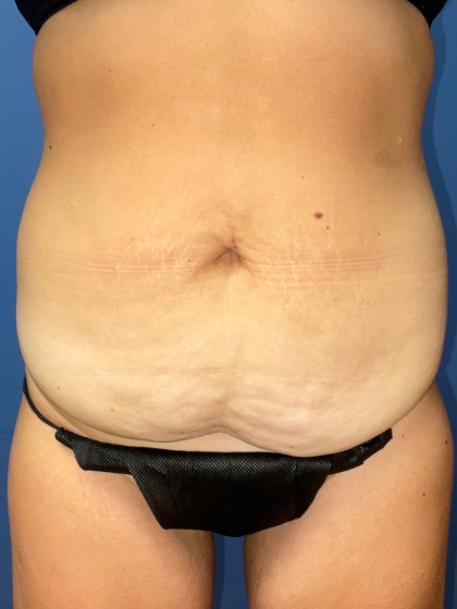 Tummy Tuck Before & After Patient #8362