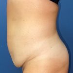 Tummy Tuck Before & After Patient #8362