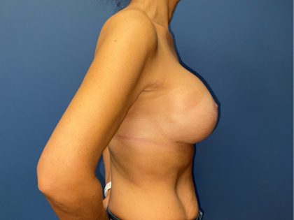 Breast Revision Before & After Patient #8553
