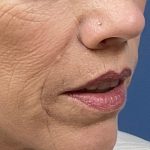Lip Lift Before & After Patient #8567