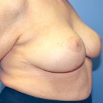Breast Reduction Before & After Patient #8503
