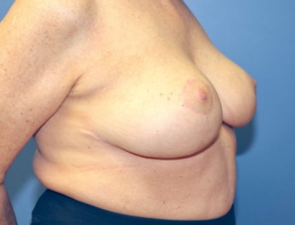 Breast Reduction Before & After Patient #8503