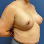 Breast Augmentation Before & After Patient #8700