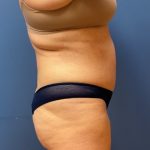 Tummy Tuck Before & After Patient #8647