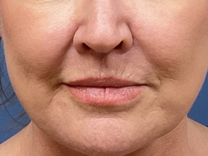 Lip Lift Before & After Patient #8625